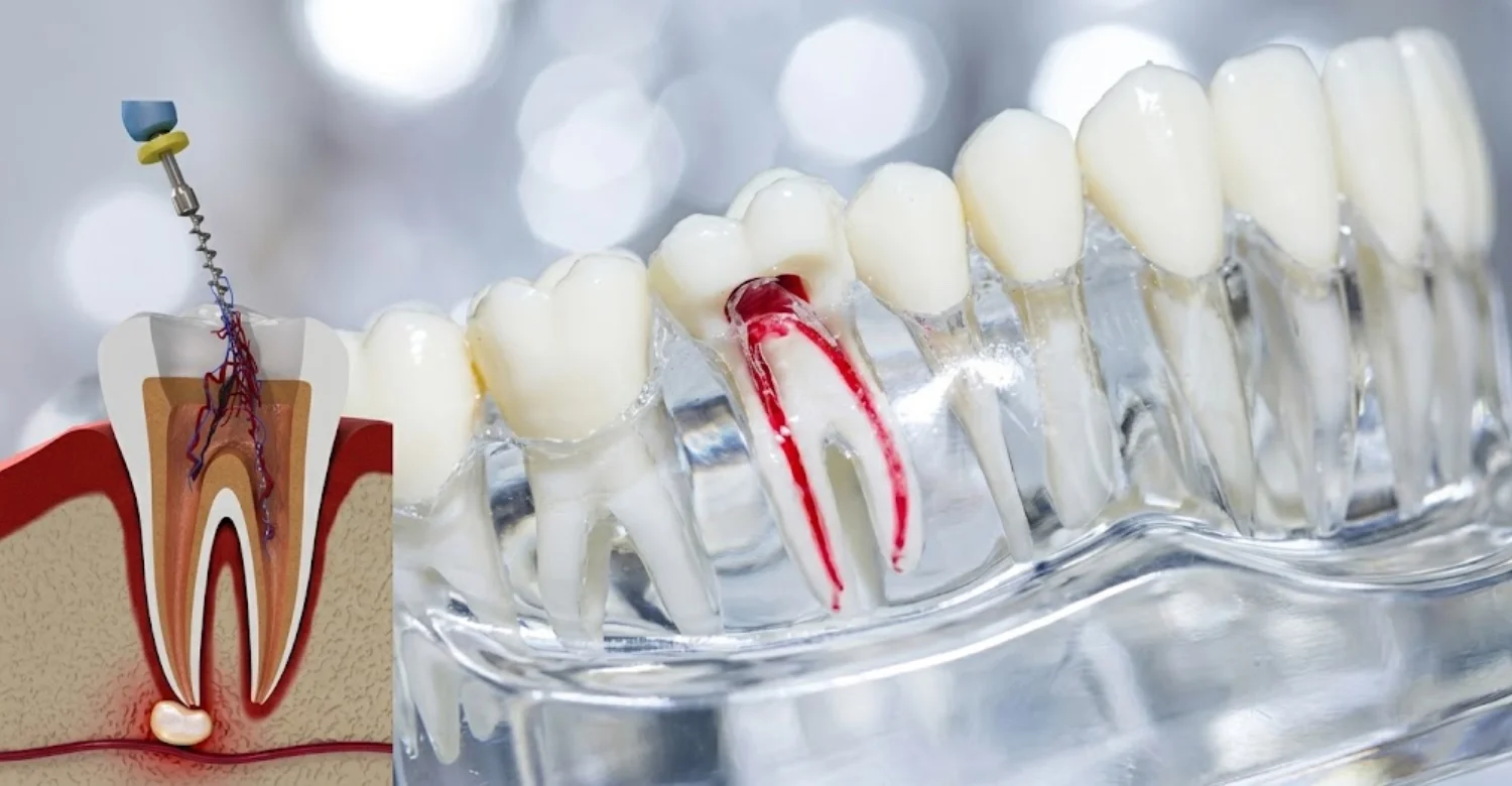 root canal pain relief 2